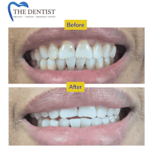 Teeth whitening and cosmetic dentistry – before and after treatment in Birmingham