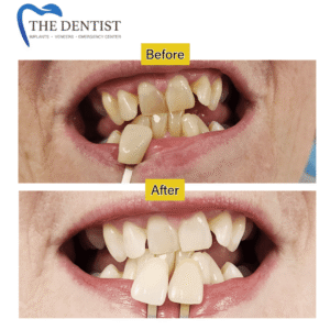 Porcelain veneers and cosmetic dentistry results in Great Barr, West Midlands
