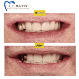Cosmetic dentistry with gold crowns – before and after results