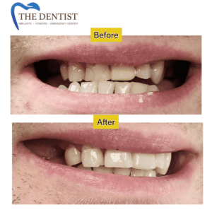 Cosmetic dentistry transformation – improved teeth alignment and shade