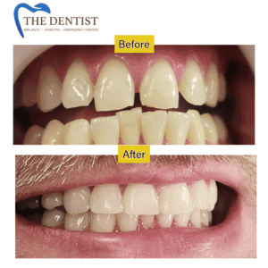 Before and after dental restoration – improved smile