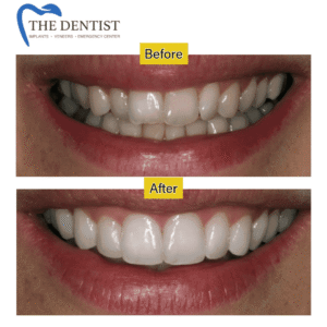Composite Bonding in West Midlands – Enhance Your Smile with Natural-Looking Aesthetic Dental Bonding at The Dentist.