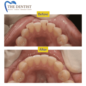 Plaque Removal & Gum Health Treatment in West Midlands – Restore Your Oral Health with Professional Deep Cleaning at The Dentist.