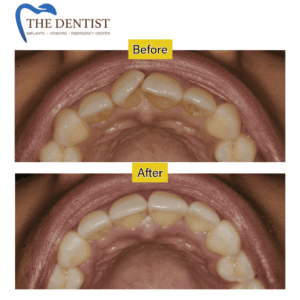 Professional Teeth Cleaning in West Midlands – Remove Stains, Tartar, and Plaque for a Healthier, Brighter Smile at The Dentist.