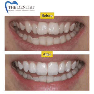 Teeth whitening before and after – Get a visibly whiter, healthier smile with professional teeth whitening at The Dentist West Midlands
