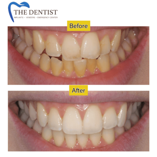 Before-and-after teeth straightening results showcasing improved alignment and a brighter smile.