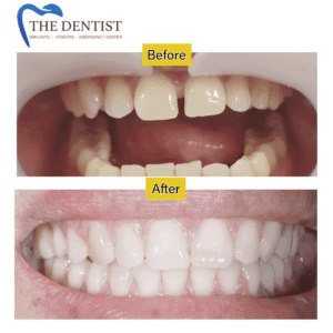 Closing Gaps for a Perfect Smile | The Dentist West Midlands