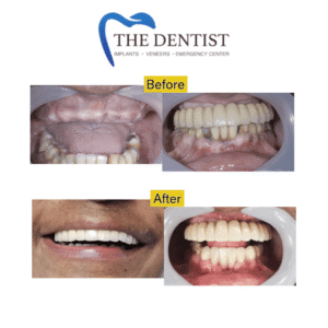Before-and-after full arch implant restoration, revealing a newly improved smile and enhanced chewing ability