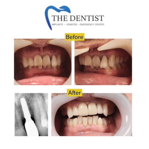 Before-and-after photos of a dental implant procedure, including an X-ray demonstrating the placed implant