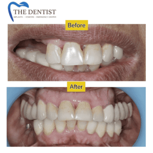 Before and after full-mouth dental implant restoration – improved smile and function by The Dentist West Midlands
