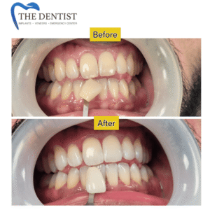 Before-and-after comparison of a successful teeth whitening procedure, showing visibly brighter teeth. teeth-whitening-result-before-after