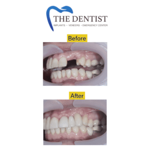 Before-and-after dental implant procedure replacing missing teeth for improved function and aesthetics