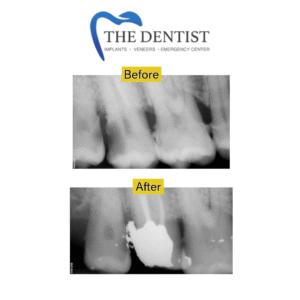 Before-and-after X-rays showing a successful root canal treatment, preserving the tooth’s natural structure