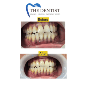 Before-and-after comparison of root canal treatment showcasing restored teeth and improved oral health