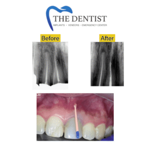 Before-and-after X-rays revealing successful root canal treatment on an upper front tooth, with a close-up showing the treatment site