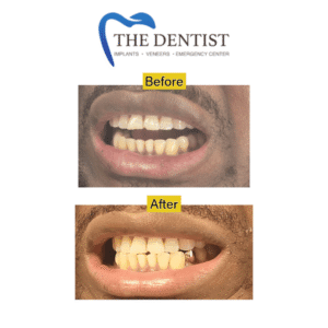 Before-and-after gold crown restoration showcasing improved aesthetics and function.