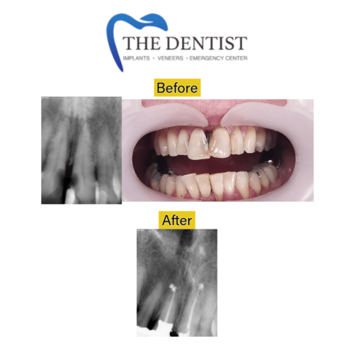 Before-and-after comparison of a root canal procedure, including X-rays showing successful treatment and restored teeth.