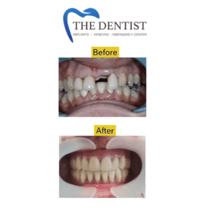 Before-and-after dental implant procedure replacing missing teeth for improved function and aesthetics