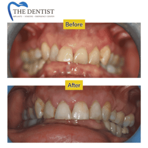 Full Mouth Dental Restoration – Before & After Crowns and Veneers | The Dentist West Midlands.
