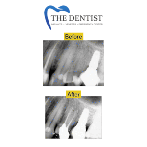 Before-and-after X-rays showing successful root canal treatment.